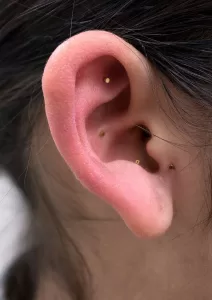 Auricular Acupuncture treatment